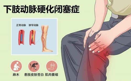 動(dòng)脈硬化